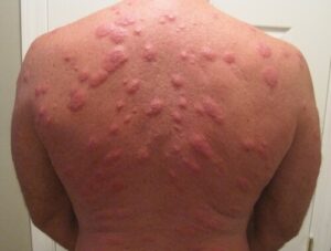 Sintomi di una puntura di cimice da letto sapere quali sono i segnali da cercare quando si sospetta uninfestazione da cimici da letto
