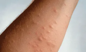Persona che utilizza prodotti naturali per eliminare gli acari della pelle, concept relativo allarticolo sugli effetti delle punture degli acari sulla pelle