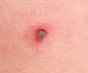 Immagine che illustra diversi metodi su come eliminare le zecche in casa come parte delle precauzioni da prendere per prevenire le punture di zecche