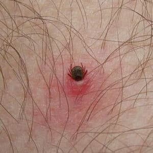 Professionista che esegue la disinfestazione delle zecche su un prato