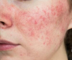 Operatore professionale mentre effettua il processo di disinfestazione acari su un materasso per prevenire allergie
