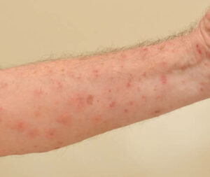 Tecnico in tuta protettiva che esegue la disinfestazione delle fognature per prevenire la presenza di acari e altri insetti che possono causare allergie