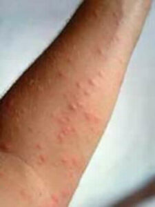 Quercia infestata da parassiti della Processionaria con evidenti segni di danni causati dal contatto con linsetto, rilevante per un articolo sui sintomi e reazioni allergiche connesse